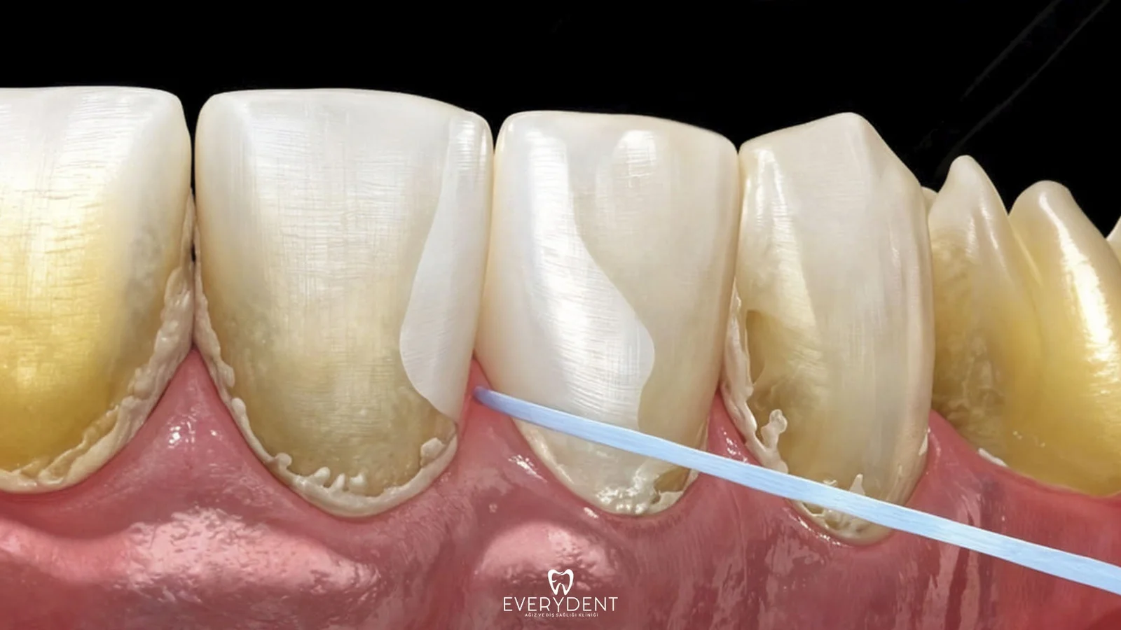 How is Dental Tartar Formed?