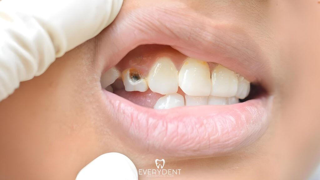 Dişlerimiz Neden Çürür