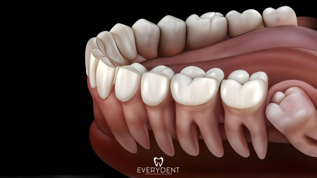 Impacted Tooth Extraction