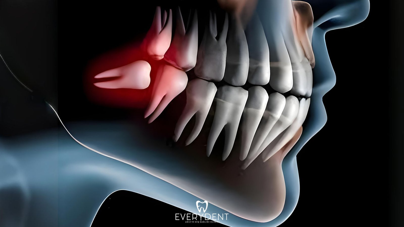 Impacted Tooth Extraction