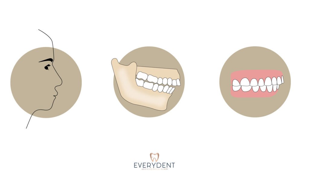 What is Malocclusion